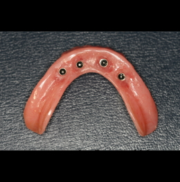 Lower Denture with O Rings